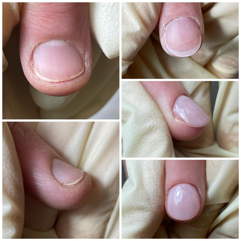 Onychophagia course